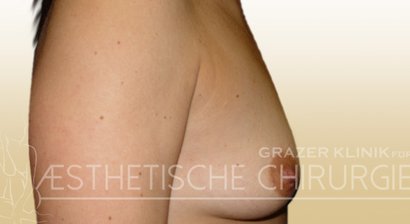 Brustvergrößerung