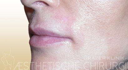 Faltenunterspritzung / Filler