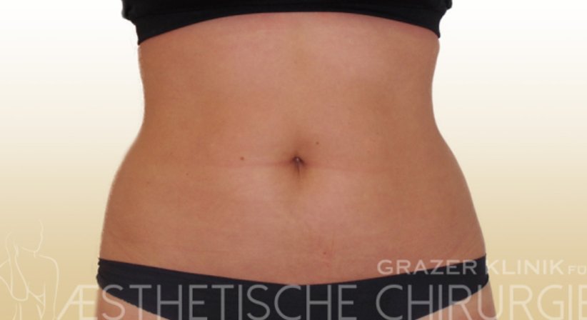 Fettabsaugung - Dr. Gunther Arco - Allgemeinchirurg Graz 8055