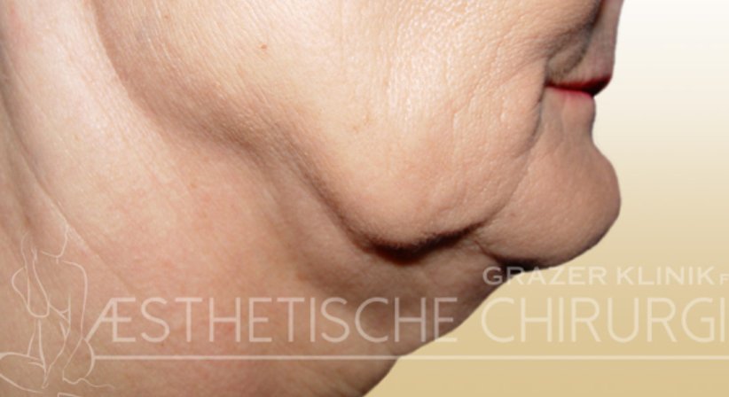 Gesicht - Dr. Gunther Arco - Allgemeinchirurg Graz 8055