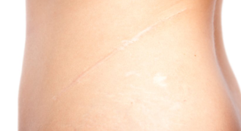 Narbenkorrektur - Dr. Gunther Arco - Allgemeinchirurg Graz 8055