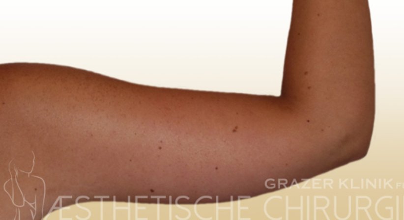 Oberarmstraffung - Dr. Gunther Arco - Allgemeinchirurg Graz 8055