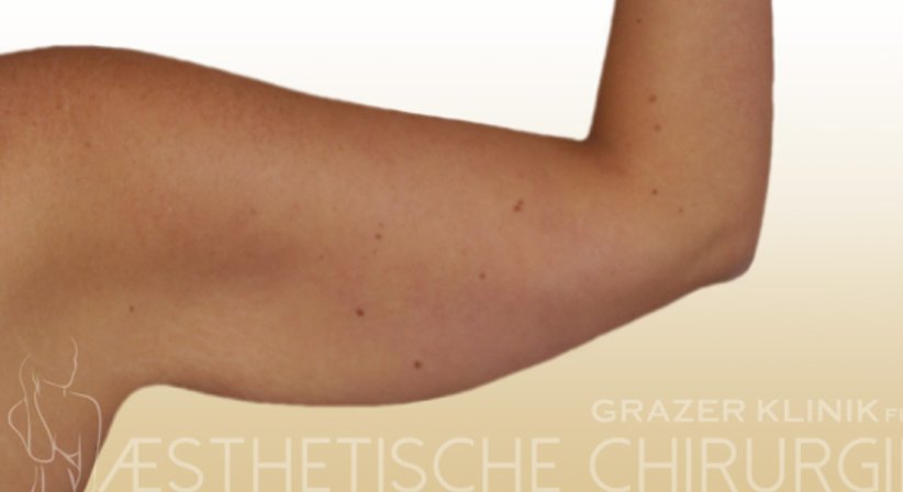 Oberarmstraffung - Dr. Gunther Arco - Allgemeinchirurg Graz 8055