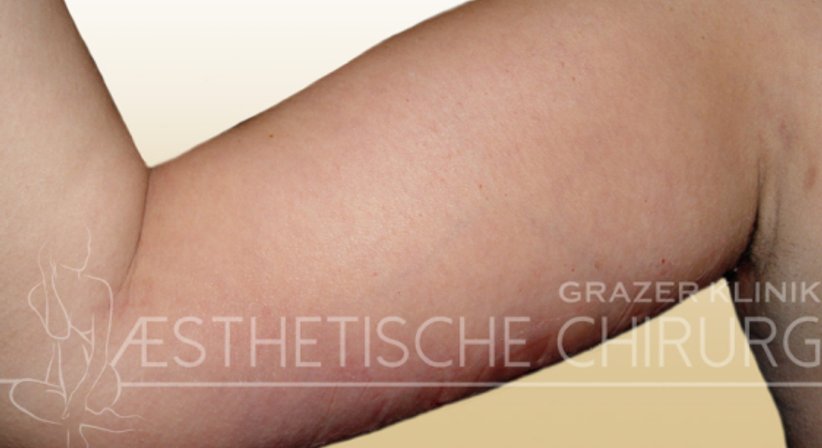 Oberarmstraffung - Dr. Gunther Arco - Allgemeinchirurg Graz 8055