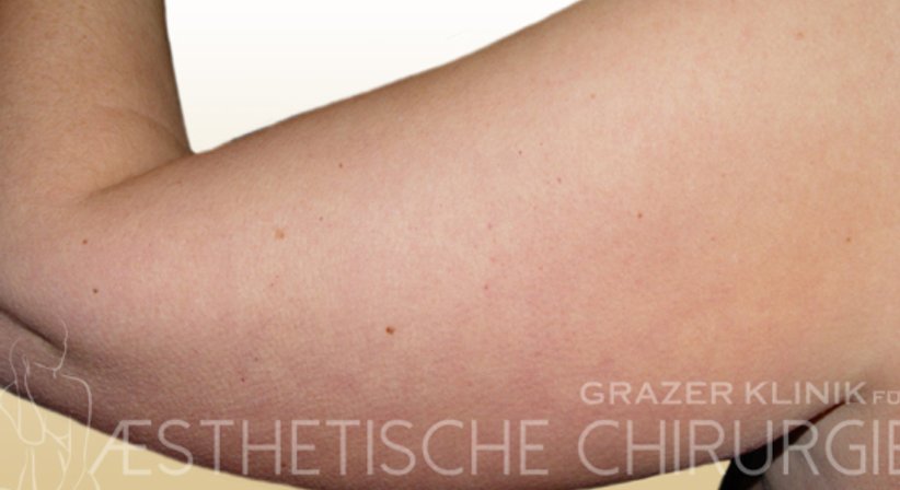 Oberarmstraffung - Dr. Gunther Arco - Allgemeinchirurg Graz 8055