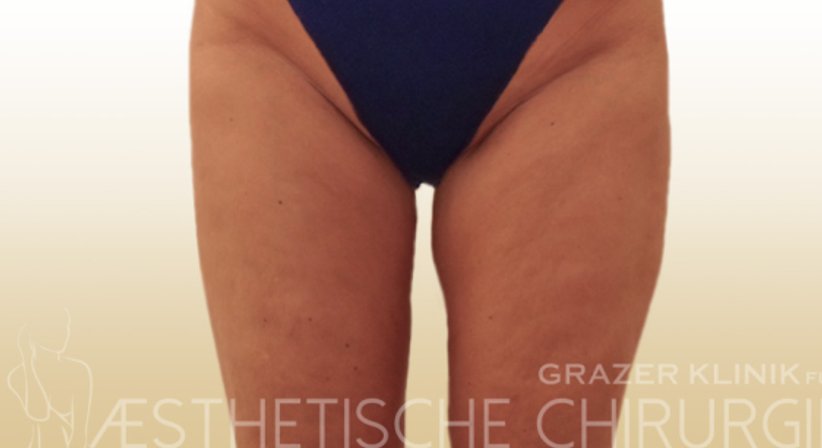 Oberschenkelstraffung - Dr. Gunther Arco - Allgemeinchirurg Graz 8055