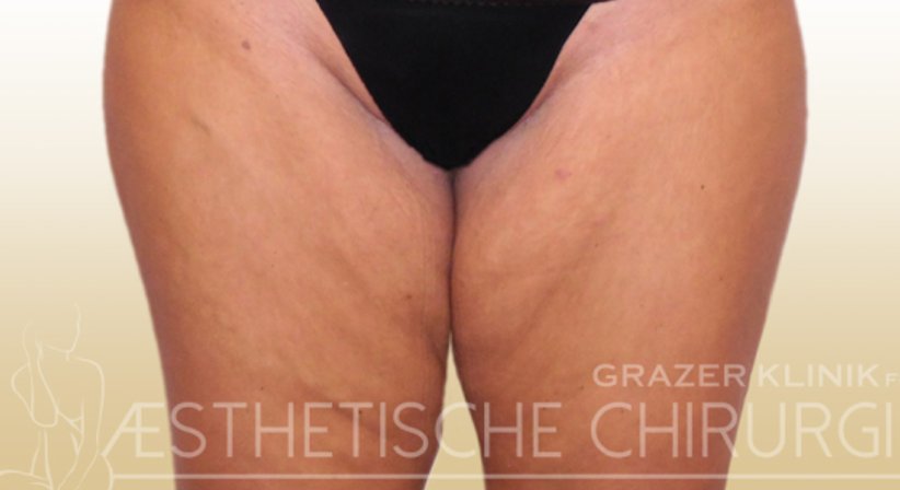 Oberschenkelstraffung - Dr. Gunther Arco - Allgemeinchirurg Graz 8055