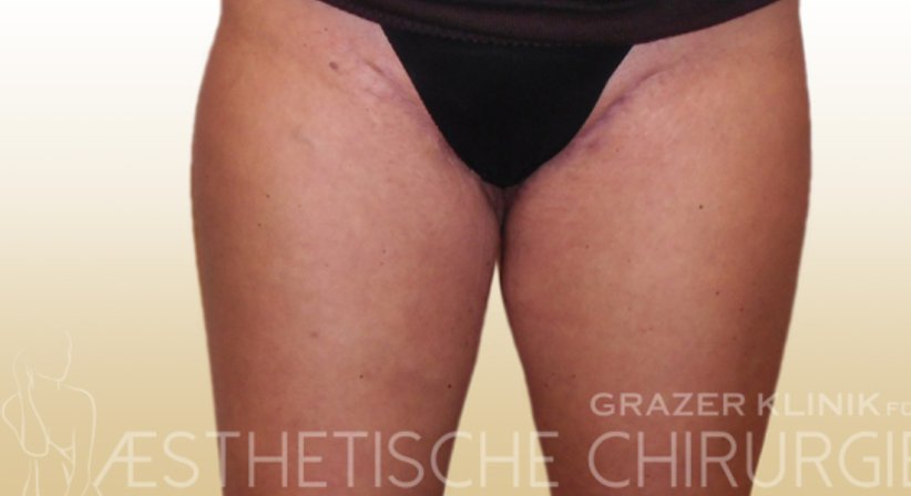Oberschenkelstraffung - Dr. Gunther Arco - Allgemeinchirurg Graz 8055