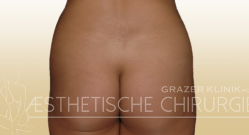 Po-Korrektur - Dr. Gunther Arco - Allgemeinchirurg Graz 8055