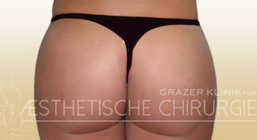 Po-Korrektur - Dr. Gunther Arco - Allgemeinchirurg Graz 8055