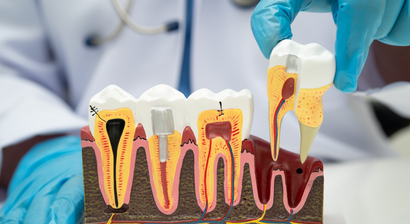 Prothetische Implantatversorgung 