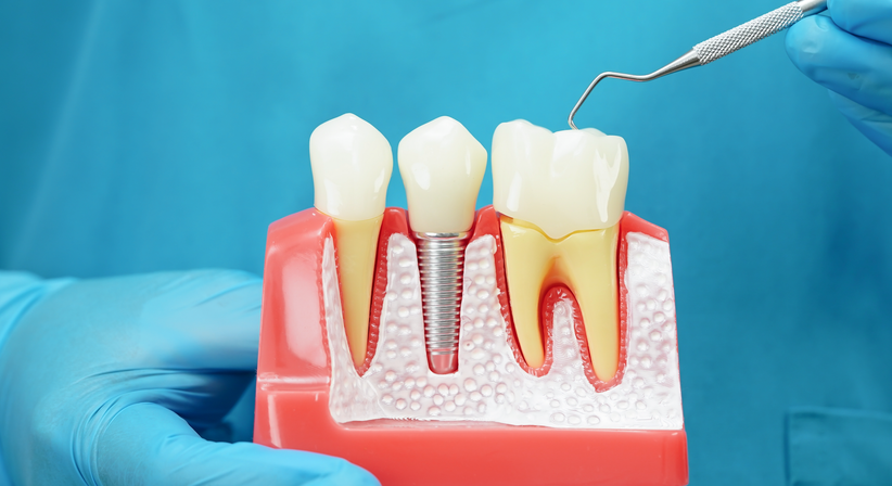 Implantologie  bei Prim. Dr. Philip Jesch, BA