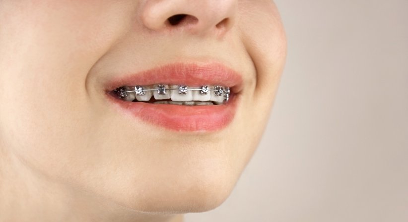 Feste Zahnspange - Dr. med. dent. Kata Korsos, M.Sc. - Zahnärztin Schärding 4780