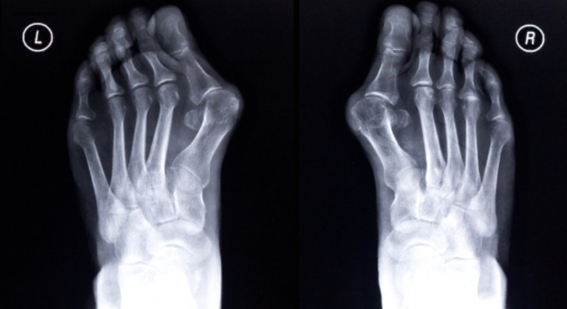 Fußchirurgie - Priv. Doz. Dr. Nicolas Aigner - Orthopäde Wien 1210