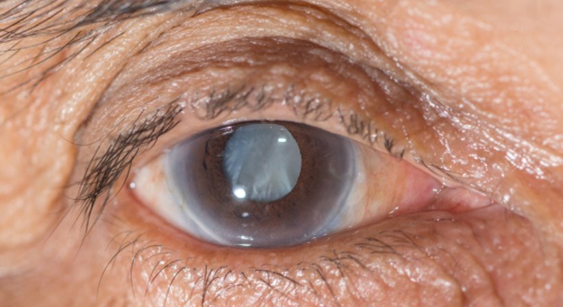 Grauer Star (Katarakt)  - Dr. Jamal Atamniy - Augenarzt Wien 1180