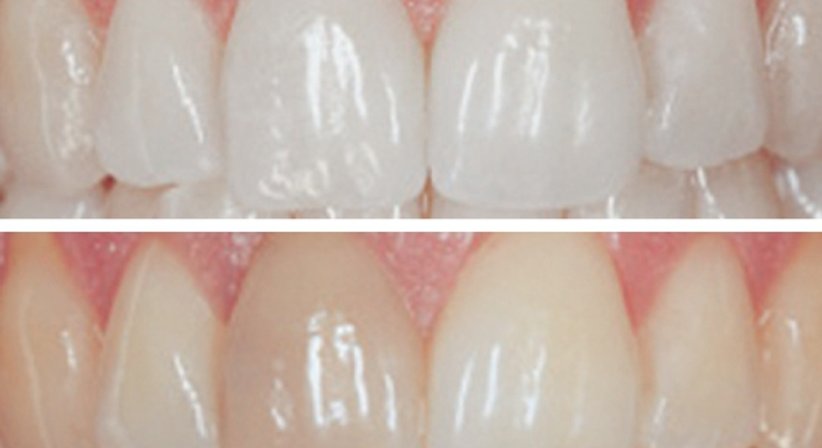 Bleaching - Dr. Gerwin V. Arnetzl - Zahnarzt Graz 8041