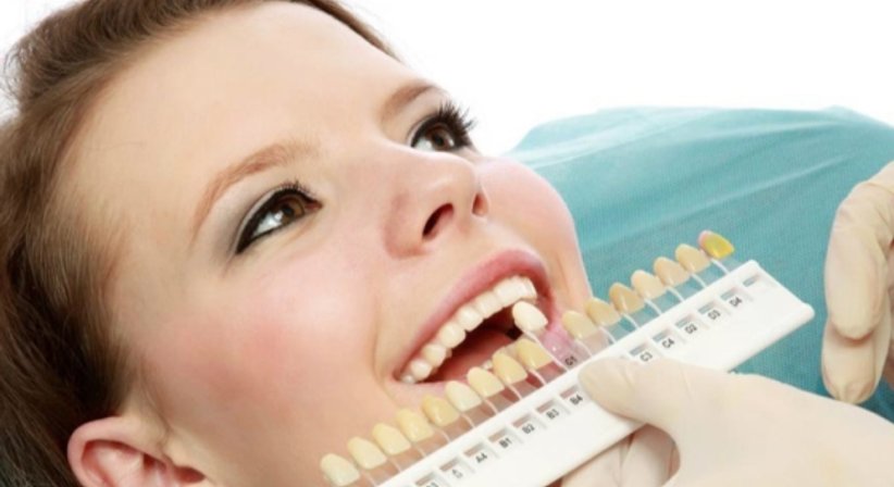 Bleaching - Dr. Gerwin V. Arnetzl - Zahnarzt Graz 8041