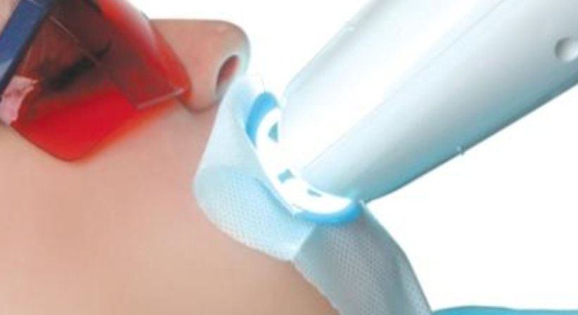 Bleaching - Dr. Gerwin V. Arnetzl - Zahnarzt Graz 8041