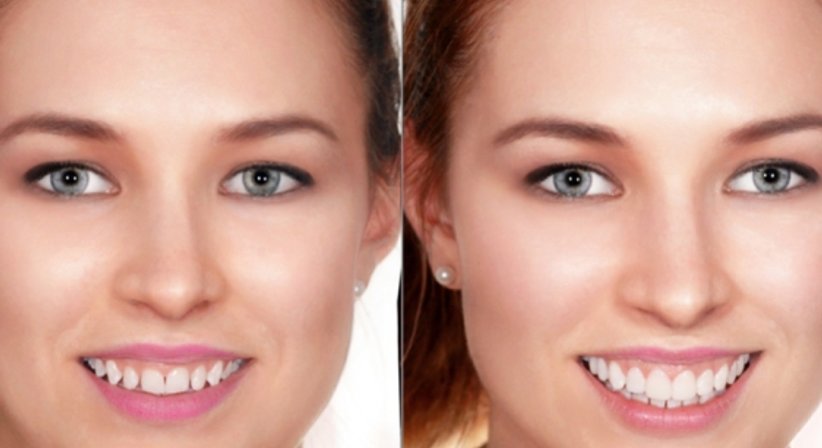 Digitales Smile Design - Dr. Gerwin V. Arnetzl - Zahnarzt Graz 8041