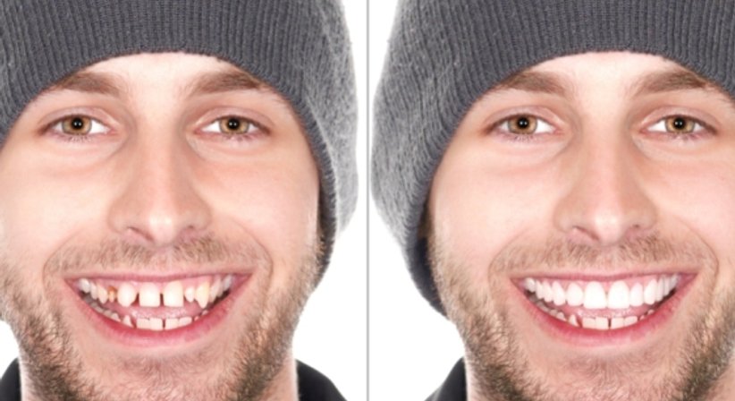 Digitales Smile Design - Dr. Gerwin V. Arnetzl - Zahnarzt Graz 8041