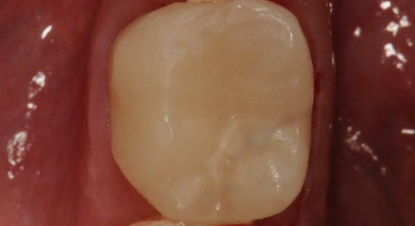 Metallfreie Füllungen - Dr. Gerwin V. Arnetzl - Zahnarzt Graz 8041