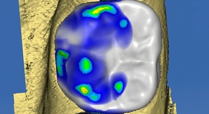 Metallfreie Füllungen