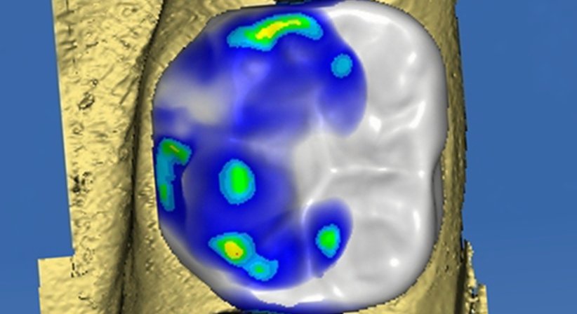 Metallfreie Füllungen - Dr. Gerwin V. Arnetzl - Zahnarzt Graz 8041