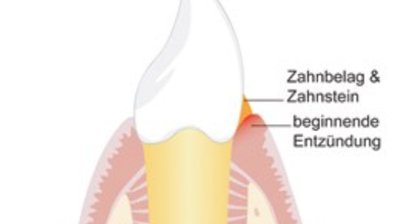 Parodontitisbehandlung