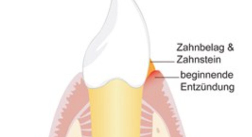 Parodontitisbehandlung - Dr. Gerwin V. Arnetzl - Zahnarzt Graz 8041