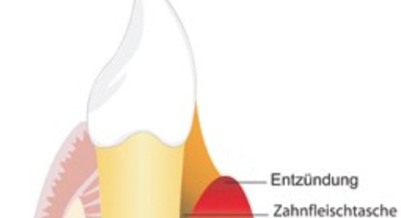 Parodontitisbehandlung - Dr. Gerwin V. Arnetzl - Zahnarzt Graz 8041
