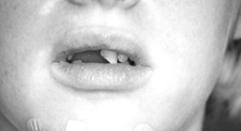 Sportmundschutz - Dr. Gerwin V. Arnetzl - Zahnarzt Graz 8041