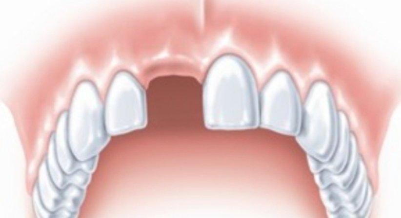 Zahnimplantate - Dr. Gerwin V. Arnetzl - Zahnarzt Graz 8041