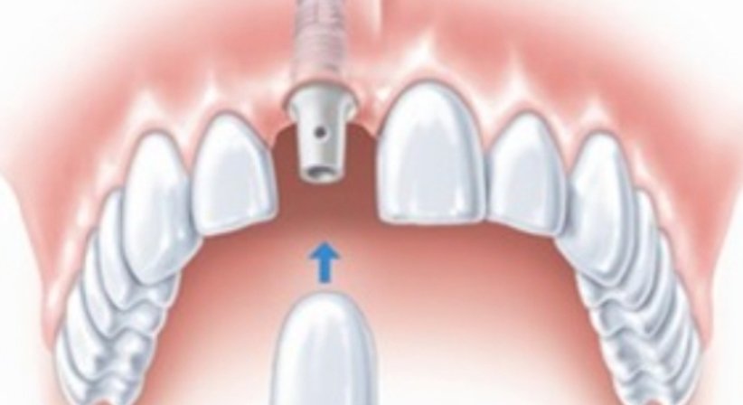 Zahnimplantate - Dr. Gerwin V. Arnetzl - Zahnarzt Graz 8041