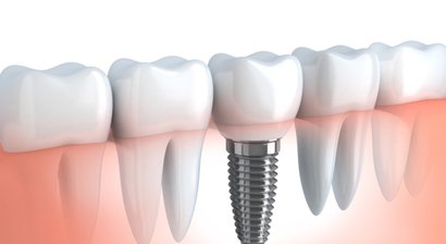 Implantologie - Oral Chirurgie