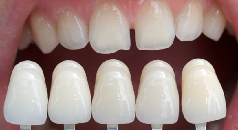 Veneers - Dr.med.univ. Thomas Merhaut, MSc - Zahnarzt Wien 1010