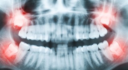 Weisheitszähne - Zysten