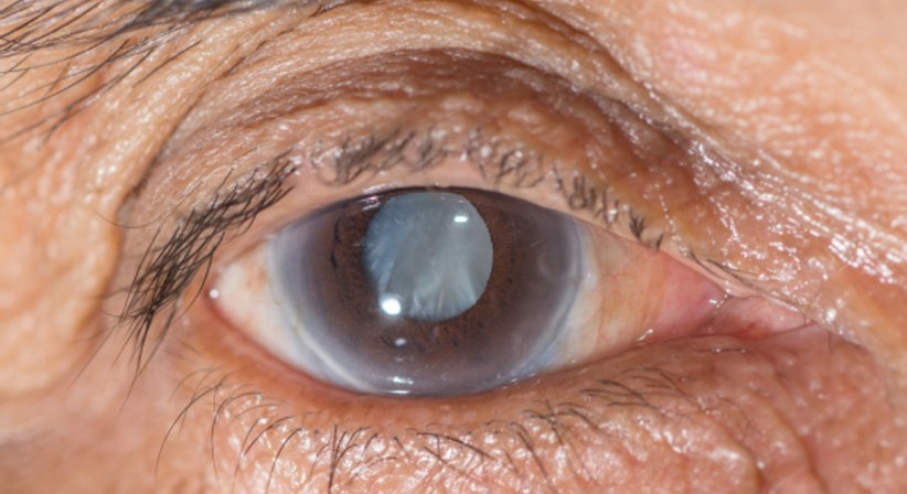 Grauer Star - Univ. Prof. Dr. Andreas Kruger - Augenarzt Wien 1090