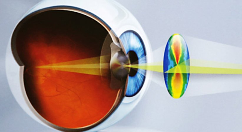 LASIK - Univ. Prof. Dr. Andreas Kruger - Augenarzt Wien 1090