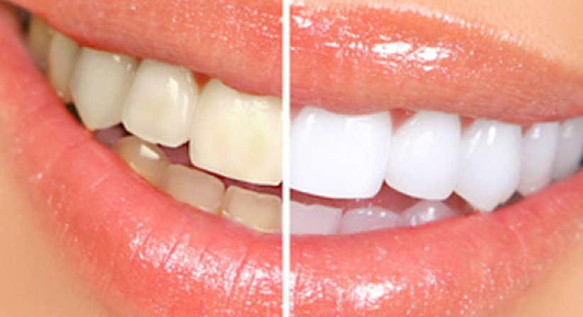 BLEACHING - DDr. Karl Jungwirth - Zahnarzt Wien 1210