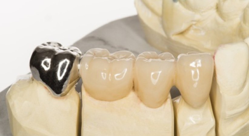 KRONEN / BRÜCKEN - DDr. Karl Jungwirth - Zahnarzt Wien 1210