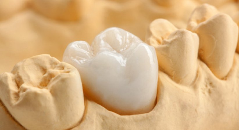 ZAHNFÜLLUNGEN - DDr. Karl Jungwirth - Zahnarzt Wien 1210