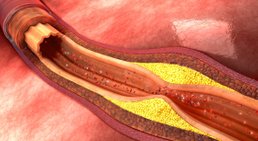 Arteriosklerose -