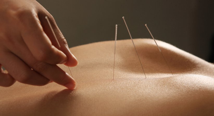 Dry Needling - Assoz. Prof. Priv. Doz. Dr. Mathias Glehr - Orthopäde Graz 8010