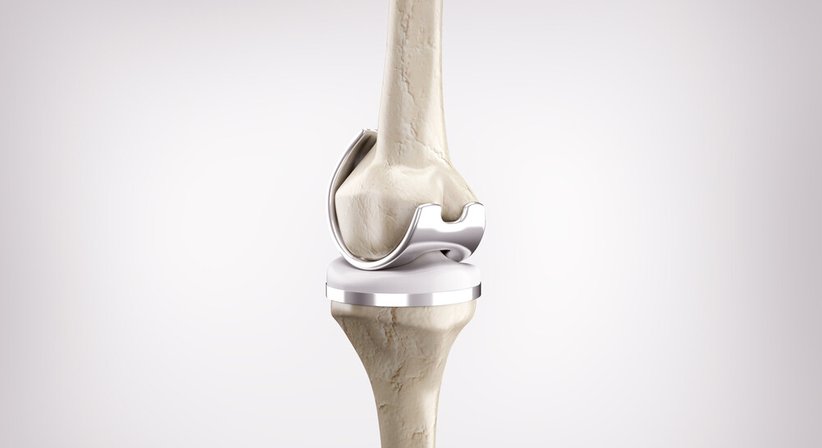 Implantation von Knie- und Hüftprothesen - Assoz. Prof. Priv. Doz. Dr. Mathias Glehr - Orthopäde Graz 8010