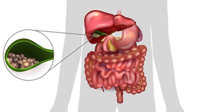 Erkrankungen der Gallenblase