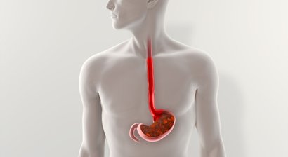 Gastroösophageale Refluxkrankheit / Sodbrennen