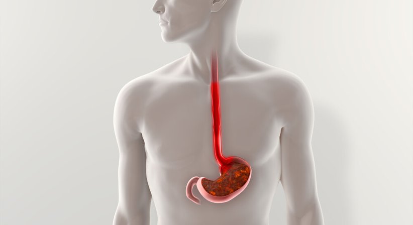 Gastroösophageale Refluxkrankheit / Sodbrennen - OA Dr. Christoph Pümpel - Internist Wien 1060