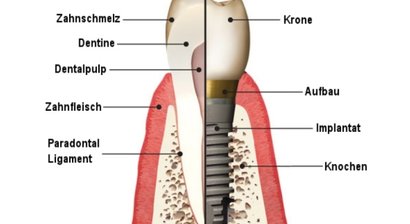 Zahnimplantate