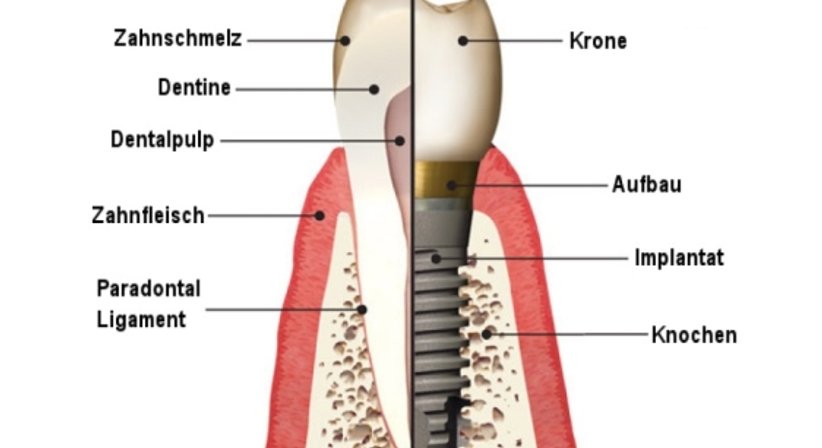 Zahnimplantate - Dr. med.dent. Martin Schiffl - Zahnarzt Salzburg 5020