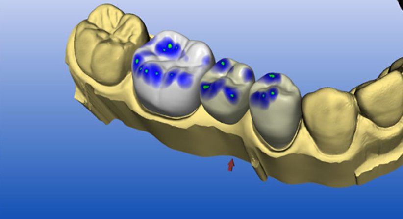Zahnkrone & Inlay - Dr. med.dent. Martin Schiffl - Zahnarzt Salzburg 5020